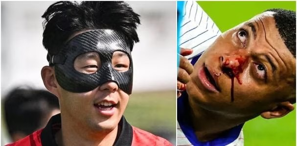 Kylian Mbappé jugará en la Eurocopa 2024 con una máscara de policarbonato