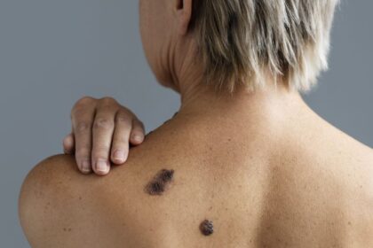 Cuales son los principales factores del cáncer de piel