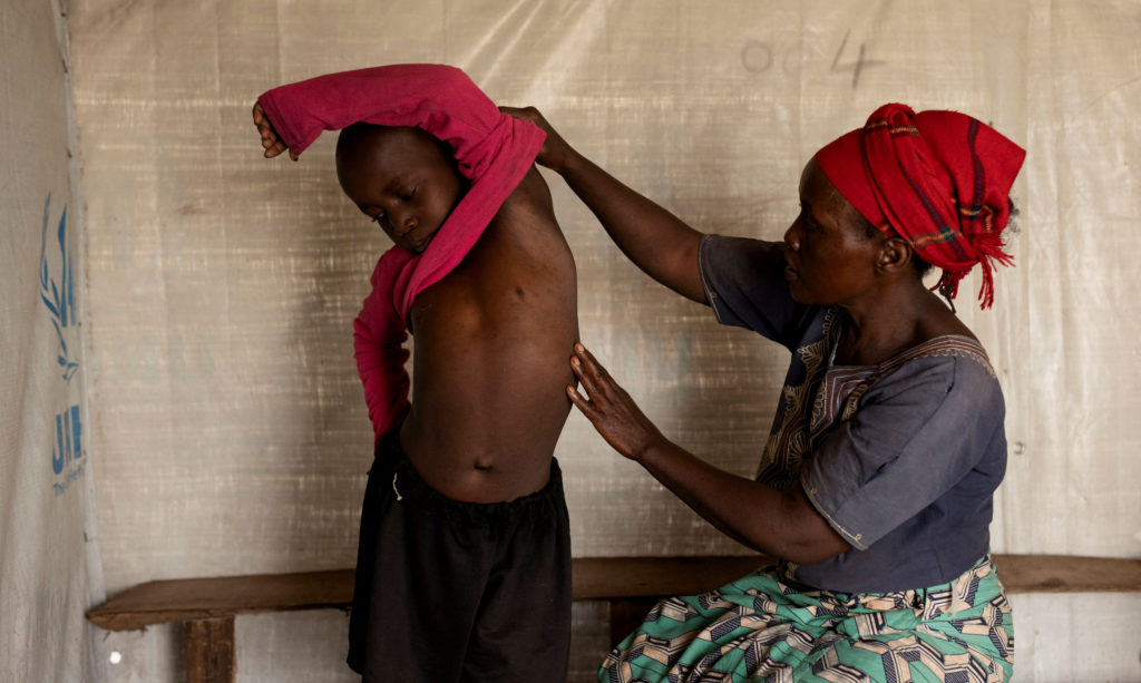 Primer caso de mpox en Pakistán activa alarmas globales