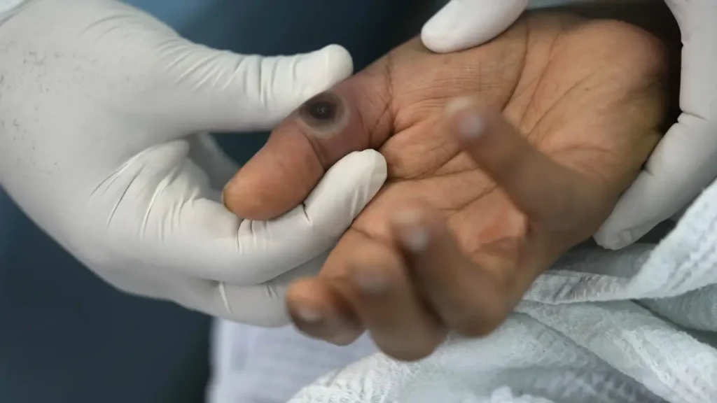 Filipinas registra su primer caso de mpox en 2024: un hombre de 33 años sin historial de viajes