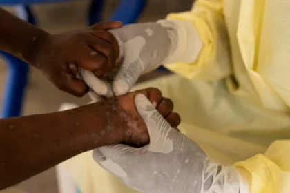 Venezuela Mpox