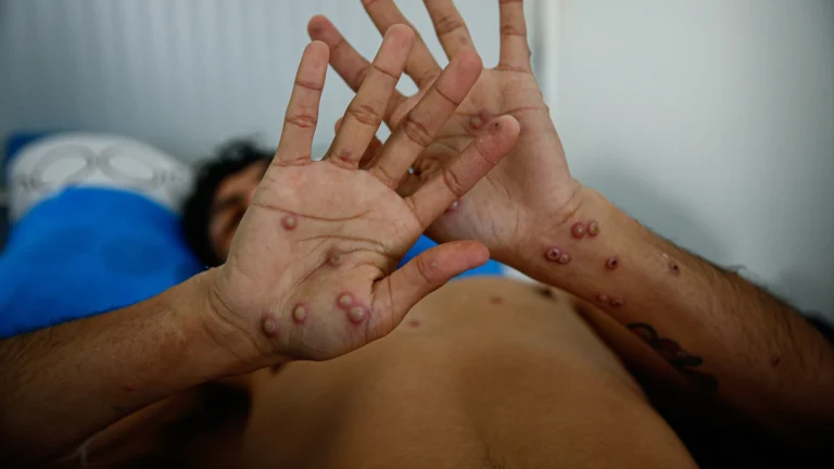 Argentina aísla un buque granelero con posible caso de mpox