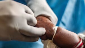 África enfrenta un brote de mpox con más de 22.800 casos confirmados