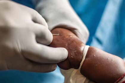 África enfrenta un brote de mpox con más de 22.800 casos confirmados