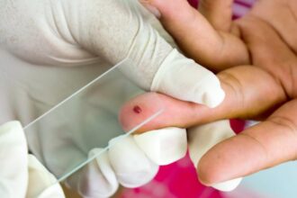 Prueba de sangre de gota gruesa para detectar el brote de malaria en Machiques de Perijá.