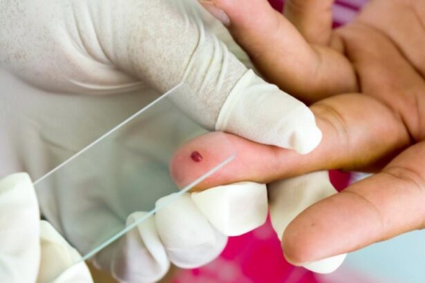 Prueba de sangre de gota gruesa para detectar el brote de malaria en Machiques de Perijá.
