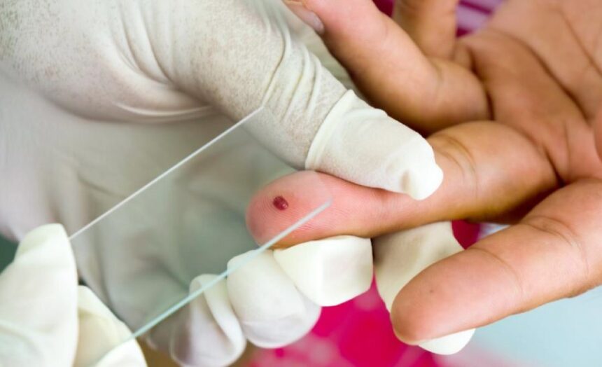 Prueba de sangre de gota gruesa para detectar el brote de malaria en Machiques de Perijá.